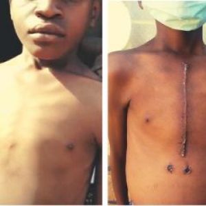 Before and after of open heart surgery